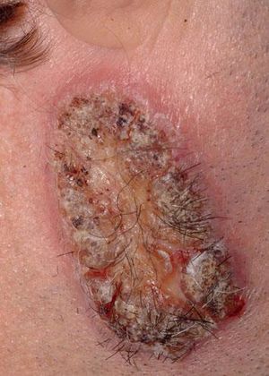 Leishmaniasis: ulcerated lesion, partially covered by crusts with infiltrated edges on the right infra-auricular area.