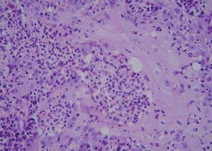 Leishmaniasis: pseudo-hyperplasia of the epidermis plus chronic inflammatory infiltrate with lymphocytes, plasma cells, and epithelioid granulomas. (hematoxylin & eosin x400)
