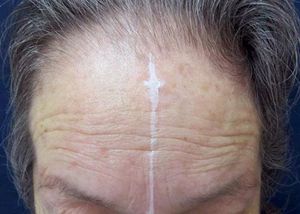 Measurement of the distance between the glabella and the frontal hairline (7.0 cm in this patient; mean distance of 5.5 cm in women)