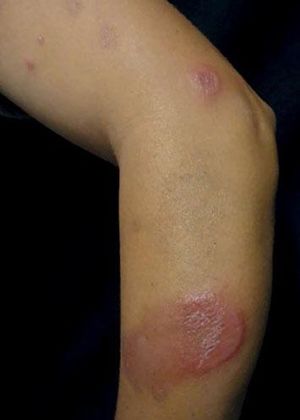 Erythematous-edematous plaques with high and precise borders in the upper limbs