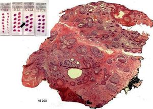 Slides and histological section of the micrographic surgery (Munich method). The tumor appears on the first three sections of slide 3 and persists througout the end without compromising the margins. The histological picture shows the cut 3 in the slide 3 (arrow) where the same histological pattern found from the biopsy can be observed. The residual tumor is not found in the center of the specimen. An ordinary sample might not have caught the tumor, neither would micrographic methods that examined only the surgical border (Hematoxylin & eosin, x20)