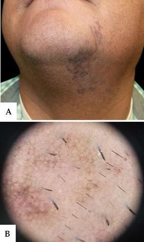 A - Linear brown macules on the left side of the chin and along the neck, with slight superficial desquamation. B - Dermoscopy showing bluish-grey dots and globules and exaggerated pseudoreticular network (black circle)