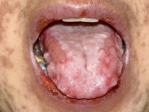 Erosions on the tongue and lips