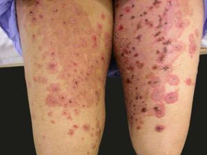 Erythema multiforme-like lesions on the thighs