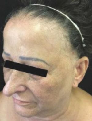 A 69-year-old female patient with frontotemporal alopecia and madarosis