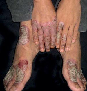 Well-demarcated hyperkeratotic erythematous to violaceous scaly plaques symmetrically involving both the dorsal surface of hands and feet, predominantly on the fingers and toes. Erosion and fissures noted on the surface