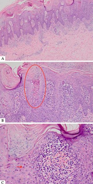 A - Hyperkeratosis, parakeratosis, psoriasiform epidermal hyperplasia with areas of spongiosis, lichenoid interface change (Hematoxylin & eosin, original magnification x40); B: Hyperkeratosis, parakeratosis, psoriasiform epidermal hyperplasia with areas of spongiosis, lichenoid interface change (Hematoxylin & eosin, original magnification x40); C: Higher magnification showing parakeratosis, scattered necrotic keratinocytes, and lymphocytic infiltration admixed with eosinophils (Hematoxylin & eosin, original magnification x200)