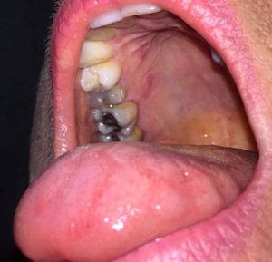 Case 1 - Geographic lesion of the hard palate associated with geographic tongue