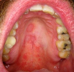Case 2 - Five days after the initial visit, raised yellowish areas surrounding the red patches appeared suggesting geographic stomatitis