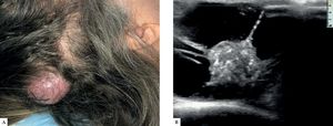 Clinical and imaging characteristics. A) Clinical examination evidencing a nodular lesion on the scalp, with a smooth surface and flexible skin, without abnormalities or phlogistic signs. B) Ultrasonography showing a cystic lesion with a heterogeneous solid area, in addition to hyperechoic areas