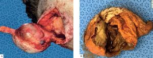 Perioperative characteristics. A) Intraoperative aspect of lesion resection. B) Macroscopic aspect of the specimen at cut surface evidencing a cystic cavity with brownish content and lumpy walls with a whitish solid area inside