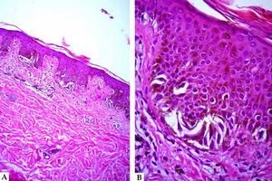 A - Basal collections of fusiform melanocytes, pigmented, and with notable nuclear atypia, papillary fibrosis, and lymphocytic infiltrate with melanophages (Hematoxylin & eosin, x10); B - Close-up (Hematoxylin & eosin, x40).