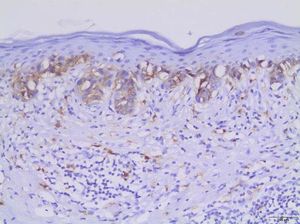 Melanoma in situ, KIT-positive. Atypical melanocytes displayed in a lentiginous pattern showing immunolabeling for KIT