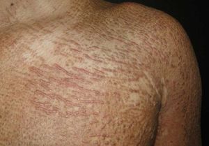 Papules arranged in a linear array