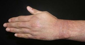 Red-to-violaceous erythematous papules affecting the upper limb