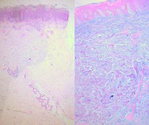 Hematoxylin & eosin and colloidal iron stain from biopsy of the patient in Figure 7 with cutaneous mucinosis of infancy. Courtesy of the Department of Anatomic Pathology, Hospital Universitario, Facultad de Medicina, Universidad Autónoma de Nuevo León