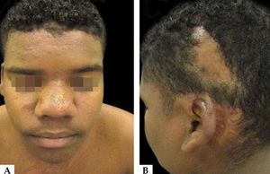 Clinical aspect of the lesions after eight months of treatment showing scaring lesions