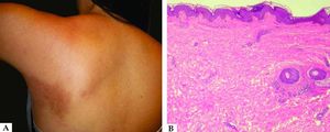 A: Hyperpig-mented, slightly depressed lesion in the infrascapular region. B: Hyper-pigmentation of the basal layer of the epidermis, perivascular inflammatory infiltrate, and slightly hyalinized collagen bundles in the reticular dermis (Hematoxylin & eosin, x100)