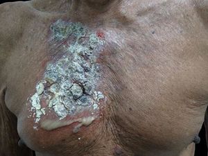 In chest, erythematous plaque, ulcerations, thick crusts, and flaccid bulla with purulent content in its lower portion