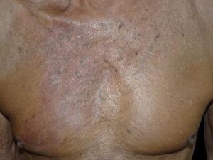 Chest without lesions or scars after treatment