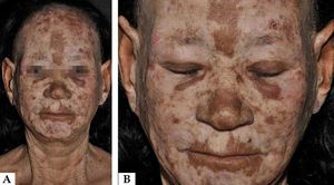 A. Diffuse sclerotic hypochromic plaques on the face with alopecia. B. Detail of the dyschromic alterations, exulcerated lesion on the forehead, alopecia of the eyebrows and temporal margins