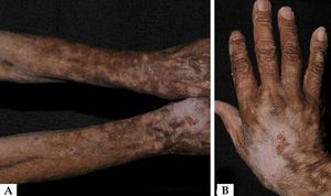 A. Sclerotic hypochromic plaques in the upper limbs. B. Detail of dyschromic sclerotic plaque, desquamation, and exulcerated lesion on the back of the hand