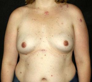 Multiple erythematous papules and hypertrophic scars on the trunk