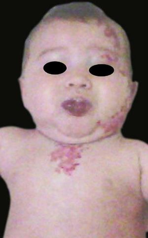 Appearance and location of lesions before treatment