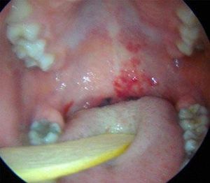 Oroscopy showing soft palate involvement with infantile hemangioma
