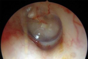 Otoscopy showing the characteristics of the tympanic membrane, atrophic and with a hemangiomatous lesion, bearing similarity to the facial lesions
