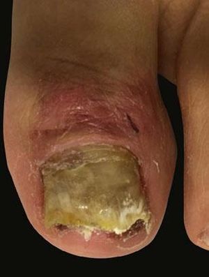 Left halux, pre-treatment. Subungual hyper-keratosis, edema and periungual erythema