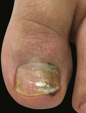 Progressive improvement of nail dystrophy five months after the first infiltration
