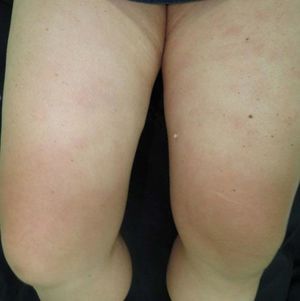 Erythematous-violaceous livedoid macules located on the knees and anterior and medial surface of the thighs