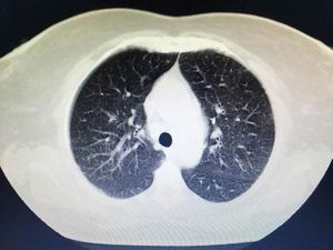 Pulmonary involvement. Chest computed tomograph findings. Diffuse bilateral distribution of multiple centrilobular nodules and bronchial wall thickness