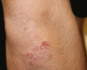 Dermatitis herpetiformis. Papules, vesicles and excoriations on the elbow