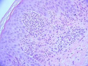 Small neutrophilic abscesses in dermal papillae and dermo-epidermal clefts overlying the abscesses. (Hematoxylin & eosin, x100)