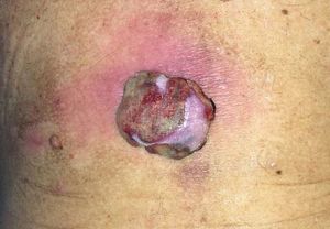 Tumoral lesion approximately 4cm in diameter, located on the lower back, with surrounding erythema