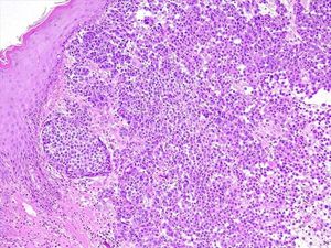 Histopathology: Confluence of nests of large, atypical melanocytes. The cells are irregular in size, shape, and spacing. Many have hyperchromatic and pleomorphic nuclei and pigmented cytoplasm (Hematoxylin & eosin, x100)