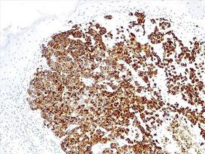 Immunohistochemistry: expression of HMB45 (HMB45, x100)