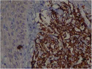 Immunohistochemistry: TCD4 diffuse positivity in 80% of lymphocytic infiltrate cells, focal positivity of 40% TCD3 cells, diffuse myeloperoxidase positivity in more than 90% of cells, TCD8 positivity in about 30% of cells, CD79a positivity in rare lymphoid cells of the dermis, Ki67 positivity in about 30% of the cells. 40× magnification.
