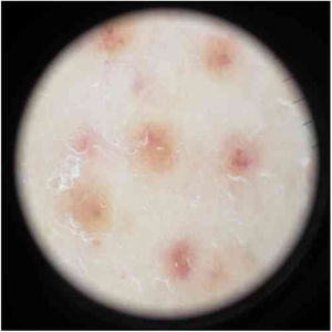 Dermatoscopy of the lesions showed red-brown spots and globules arranged on a background of coppery-red pigmentation.