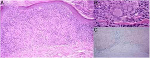 (A) Thinned epidermis, lichenoid infiltrate with lymphocytes and histiocytes forming non-necrotizing granulomas in the dermis and erythrocyte extravasation (hematoxylin & eosin, ×100). (B) Small non-necrotizing granulomas in the dermis formed by deposits of epithelioid cells and multinucleated giant cells (hematoxylin & eosin, ×400). (C) Erythrocyte extravasation and hemosiderin deposits in the dermis, especially under the inflammatory deposits with granulomas (Prussian blue iron stain, ×100).