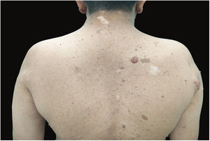 Café-au-lait macules, neurofibromas with perilesional halo, and vitiligo patches over the back.