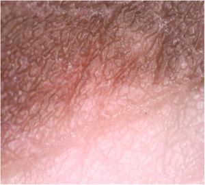 Border of a lesion on dermoscopy, showing reduced pigmentary network in the lesion compared to normal skin.