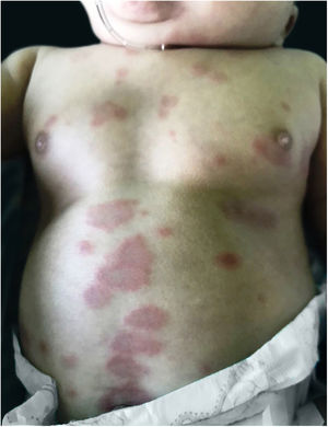 Erythematous annular plaques with lighter centers in the abdomen.