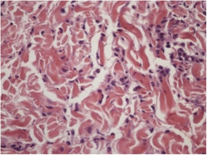Interstitial histiocytic infiltrate with eosinophils. Hematoxylin & eosin, ×400.