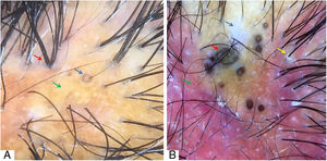 (A) “3D” yellow dot (blue arrow), polytrichia (red arrow), and yellow areas (green arrow). (B) Amorphous white area (blue arrow), large brown dots (red arrow), diffuse erythema (green arrow), perifollicular scales (yellow arrow). Trichoscopy performed with 3Gen DermLite® II Hybrid M with polarized light and interface liquid (A) and without interface liquid (B) (alcohol 70%); ×20 magnification.