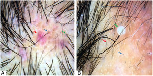 (A) Red dots (blue arrow), peri- and interfollicular erythema (red arrow), and perifollicular gray-blue pigmentation (green arrow). (B) Black dots (blue arrow), exclamation mark, and dystrophic hairs (red arrow) and pustule (green arrow) Trichoscopy performed with 3Gen DermLite® II Hybrid M with polarized light and with interface liquid (70% alcohol); ×20 magnification.