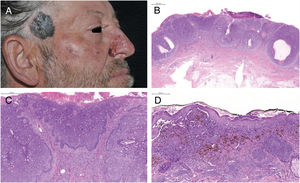 (A) Basal cell carcinoma (BCC) – nasal; melanoma – right temporal region. (B) BCC – clusters of basaloid cells (Hematoxylin & eosin, ×10). (C) Peripheral palisading of cells (Hematoxylin & eosin, ×100). (D) Melanoma – nests of atypical melanocytes and pagetoid spread (Hematoxylin & eosin, ×200).
