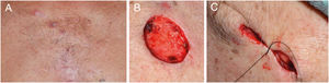 (A) Basal cell carcinomas (BCCs) on the sternal region; (B) surgical excision; (C) synthesis and “dog ear.”.